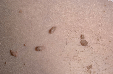 Papiloma