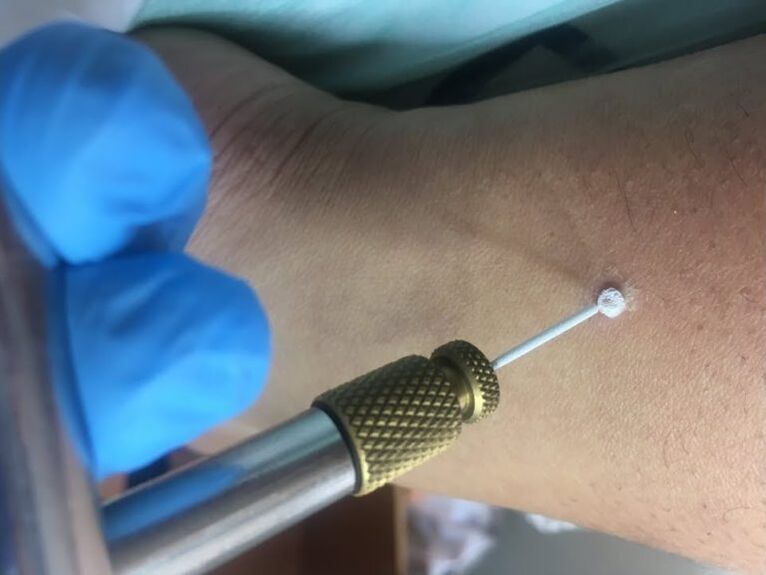 modalități de a elimina negii