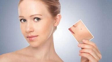 revizuirea remediilor eficiente pentru veruci și papiloame