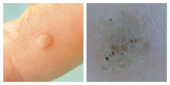 Negi obișnuite în timpul examinării și dermatoscopiei