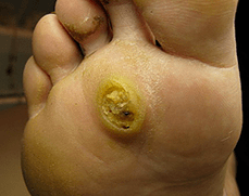 Papilamele subanare