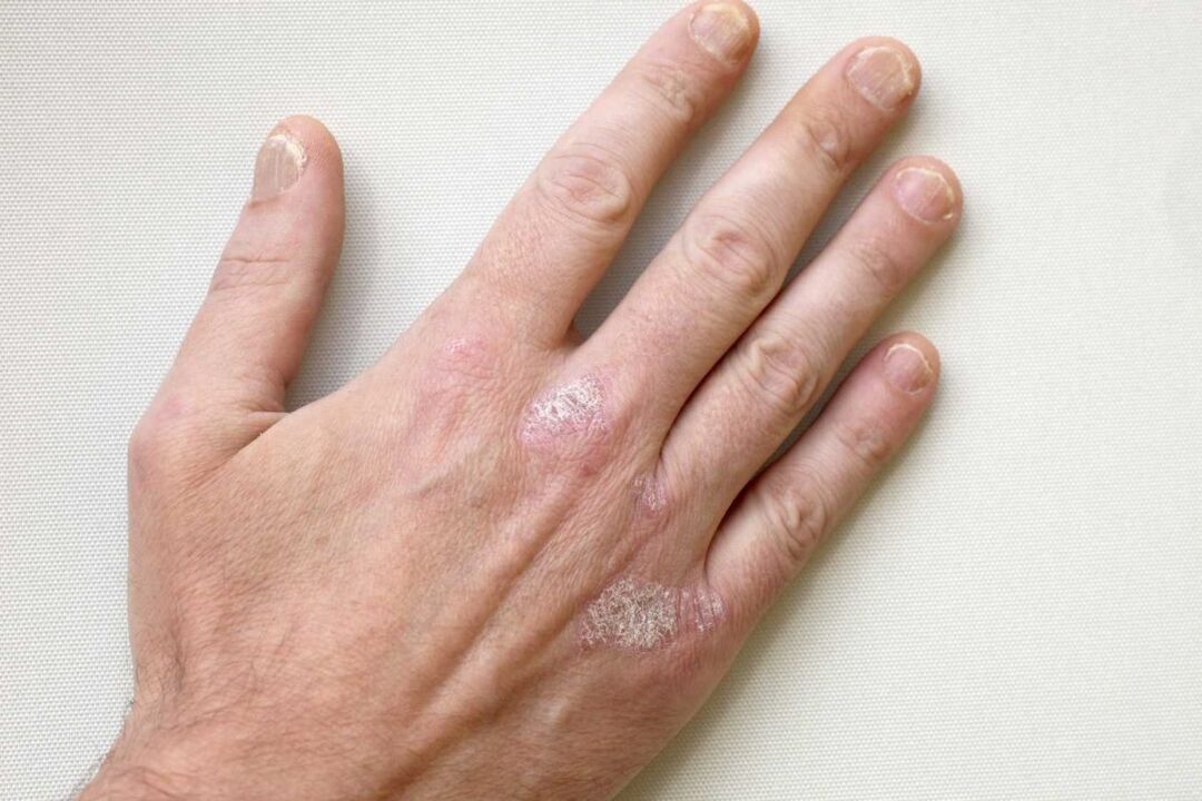psoriazis pe mainile unui barbat tratament cu crema Keramin